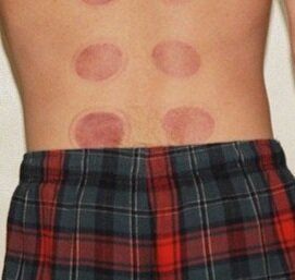 No Difference Between Cupping And Placebo Cupping For Chronic Low Back